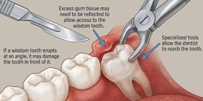 Diagnostic imaging for tooth extractions at Junction House Dental