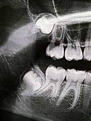 Comfortable wisdom tooth assessment and extraction at Junction House Dental